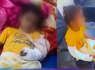 देब्रे हात भाँचिएका बालकको दाहिनेमा प्लास्टर गरेपछि